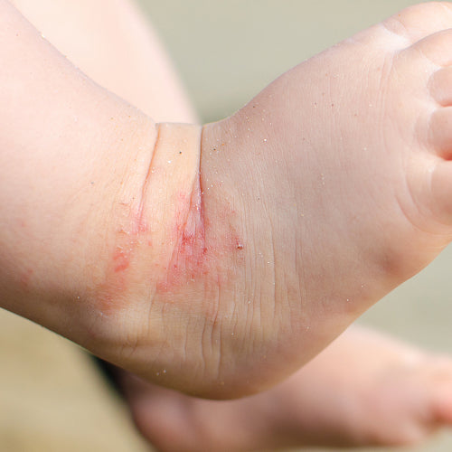 Baby foot with eczema