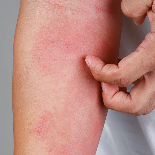 Hand scratching the bottom part of the arm that is red & irritated