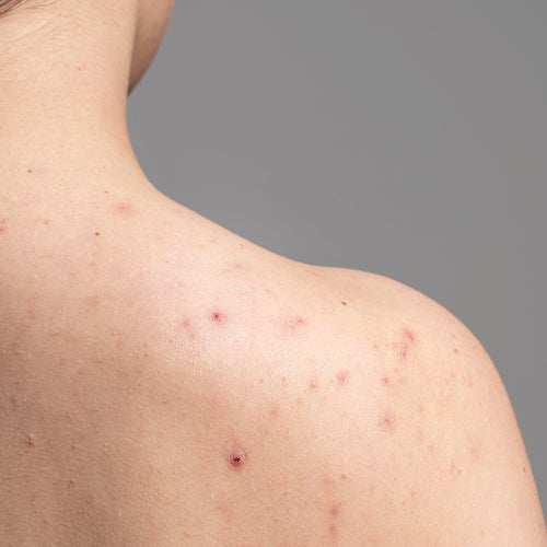 Skin breakouts on back