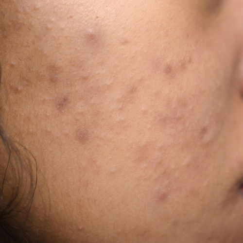 Skin breakouts on cheek