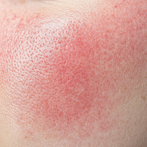 Skin sensitivity and redness on cheek