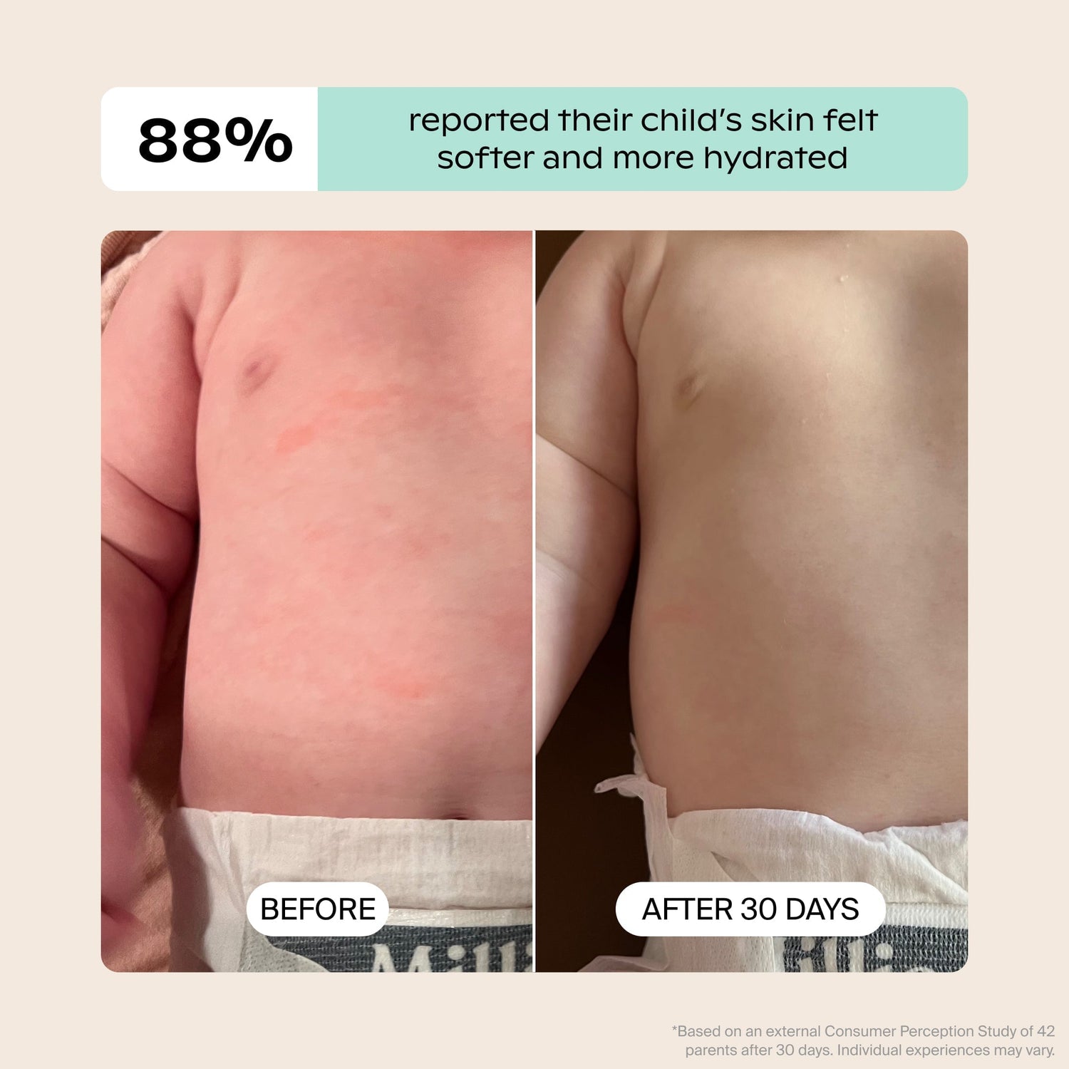 Baby Bath Tub Filter | Lifestyle, Before & After illustrating a child's irritated belly with redness that has faded over 30 days; Based on an external Consumer Perception Study of 42 parents 88% reported their child's skin felt softer and more hydrated