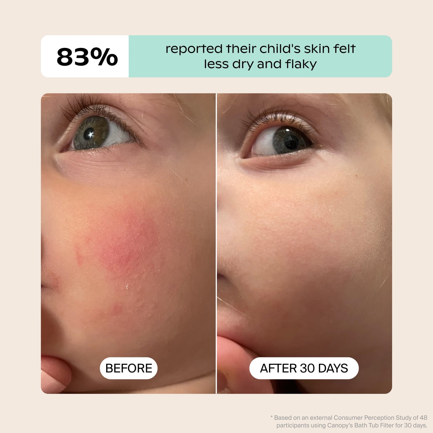 Baby Bath Tub Filter | Lifestyle, Before & After illustrating a child's irritated cheek with redness that has faded over 30 days; Based on an external Consumer Perception Study 83% reported their child's skin felt less dry and flaky