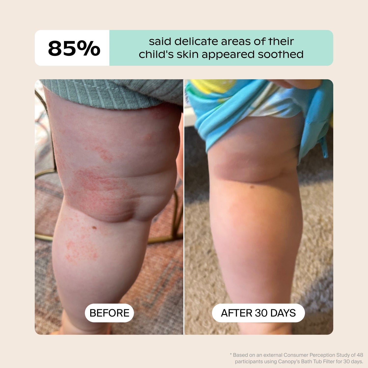 Baby Bath Tub Filter | Lifestyle, Before & After illustrating a child's irritated leg with redness that has faded over 30 days; Based on an external Consumer Perception Study 85% said delicate areas of their child's skin appeared soothed