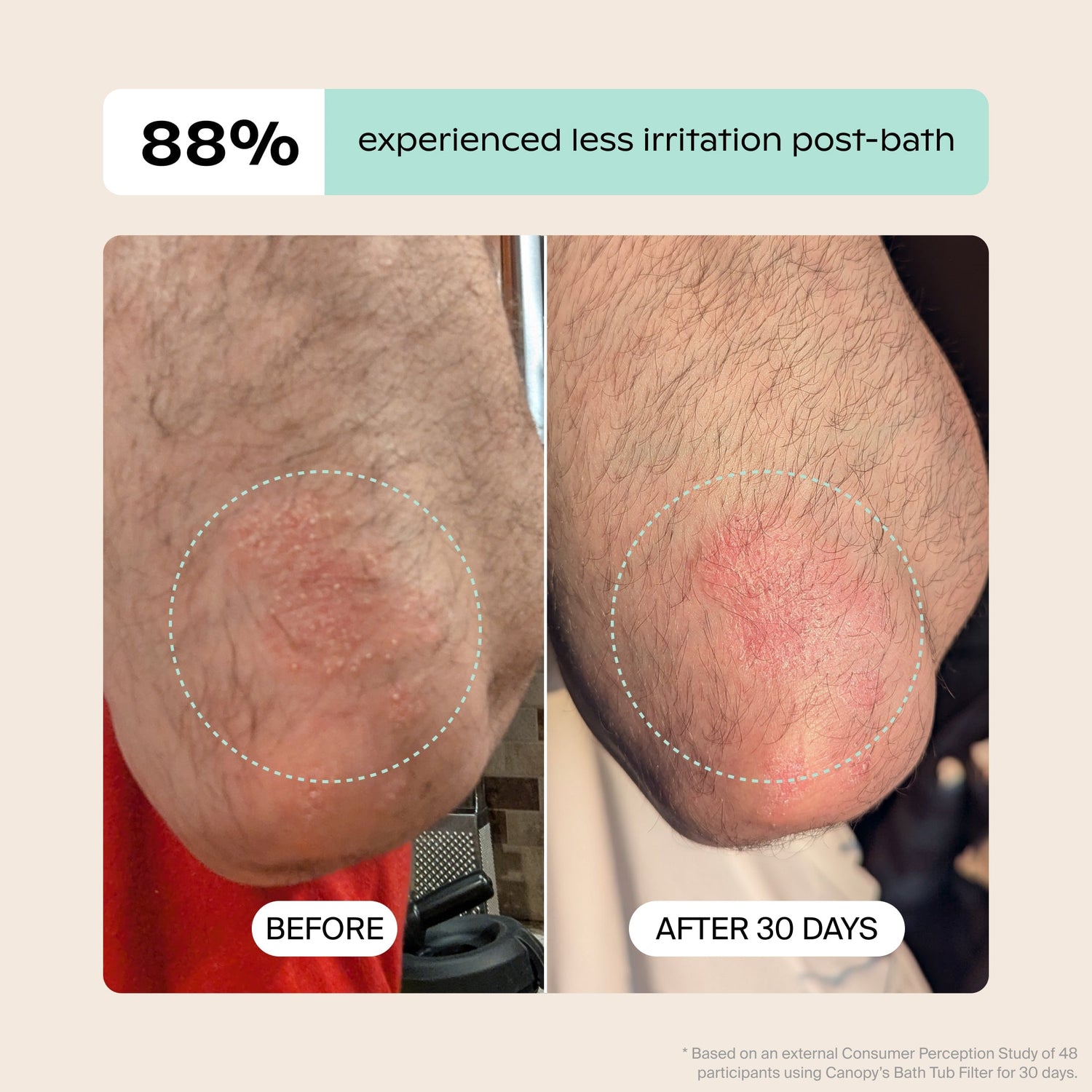 Bath Tub Filter | Lifestyle, Based on an external Consumer Perception Study of 48 participants using Canopy's Bath Tub Filter for 30 days, 88% experienced less irritation post-bath