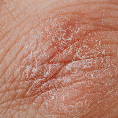 Skin irritation 